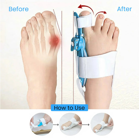 Hallux Valgus Corrector – Toe Realignment Support for Bunion Relief & Foot Comfort