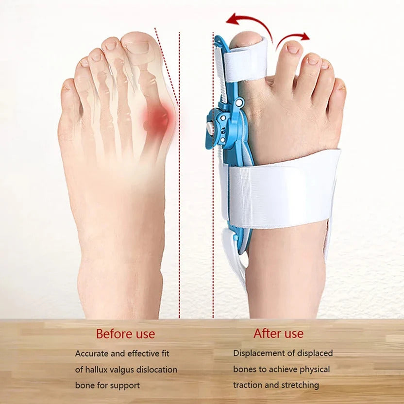 Hallux Valgus Corrector – Toe Realignment Support for Bunion Relief & Foot Comfort